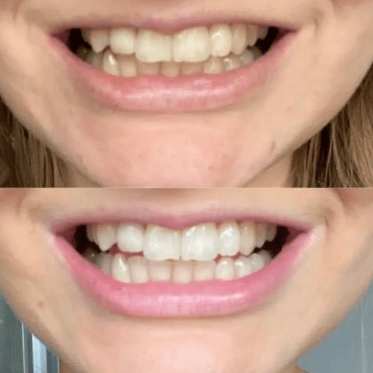 ✨Teeth Whitening Powder – Advanced PAP+ Formula for a Radiant, Healthy Smile