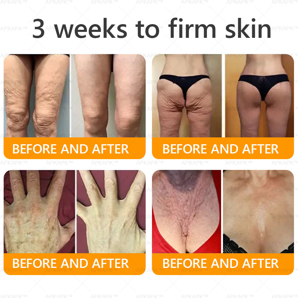 𝐀𝐏𝐊𝐀𝐏® 𝐁𝐞𝐞 𝐯𝐞𝐧𝐨𝐦 𝐒𝐤𝐢𝐧 𝐑𝐞𝐬𝐭𝐨𝐫𝐚𝐭𝐢𝐨𝐧 𝐂𝐫𝐞𝐚𝐦|𝐋𝐀𝐒𝐓 𝐃𝐀𝐘 𝟖𝟎% 𝐎𝐅𝐅💎💎 𝑃𝑜𝑤𝑒𝑟𝑓𝑢𝑙 𝑎𝑛𝑡𝑖-𝑎𝑔𝑖𝑛𝑔 𝑠𝑜𝑙𝑢𝑡𝑖𝑜𝑛 𝑡ℎ𝑎𝑡 𝑡𝑎𝑟𝑔𝑒𝑡𝑠 𝑑𝑒𝑒𝑝 𝑤𝑟𝑖𝑛𝑘𝑙𝑒𝑠, 𝑓𝑖𝑛𝑒 𝑙𝑖𝑛𝑒𝑠, 𝑠𝑎𝑔𝑔𝑖𝑛𝑔 𝑠𝑘𝑖𝑛, 𝑎𝑛𝑑 𝑑𝑟𝑦𝑛𝑒𝑠𝑠