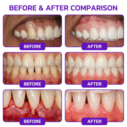 🦷 Bee Venom Toothpaste for Gingivitis & Periodontitis Care