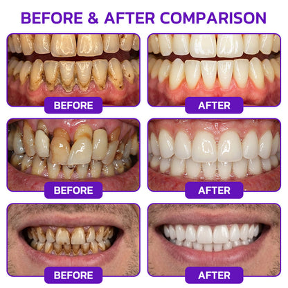 🦷 Bee Venom Toothpaste for Gingivitis & Periodontitis Care
