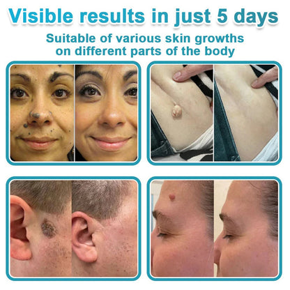 2-in-1 Microneedle & Hydrocolloid Patch👨‍⚕️ | Removes raised moles, acne, flat warts, and skin tags