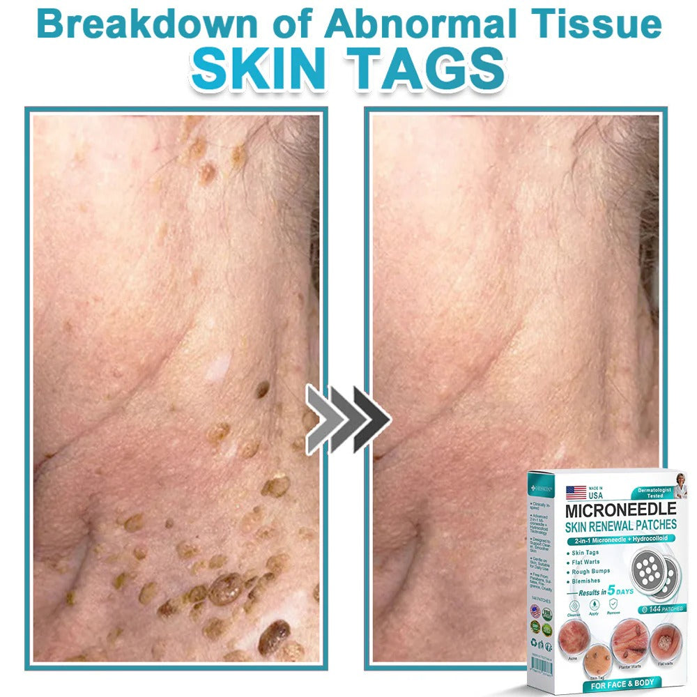 2-in-1 Microneedle & Hydrocolloid Patch👨‍⚕️ | Removes raised moles, acne, flat warts, and skin tags