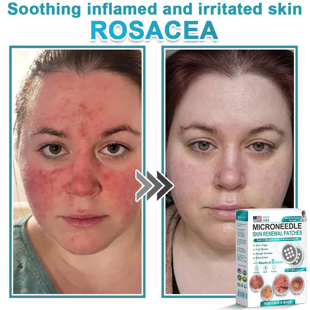 2-in-1 Microneedle & Hydrocolloid Patch👨‍⚕️ | Removes raised moles, acne, flat warts, and skin tags