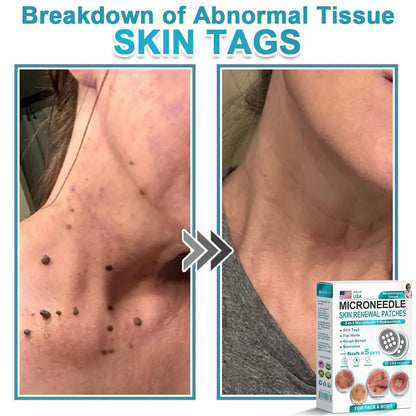 2-in-1 Microneedle & Hydrocolloid Patch👨‍⚕️ | Removes raised moles, acne, flat warts, and skin tags