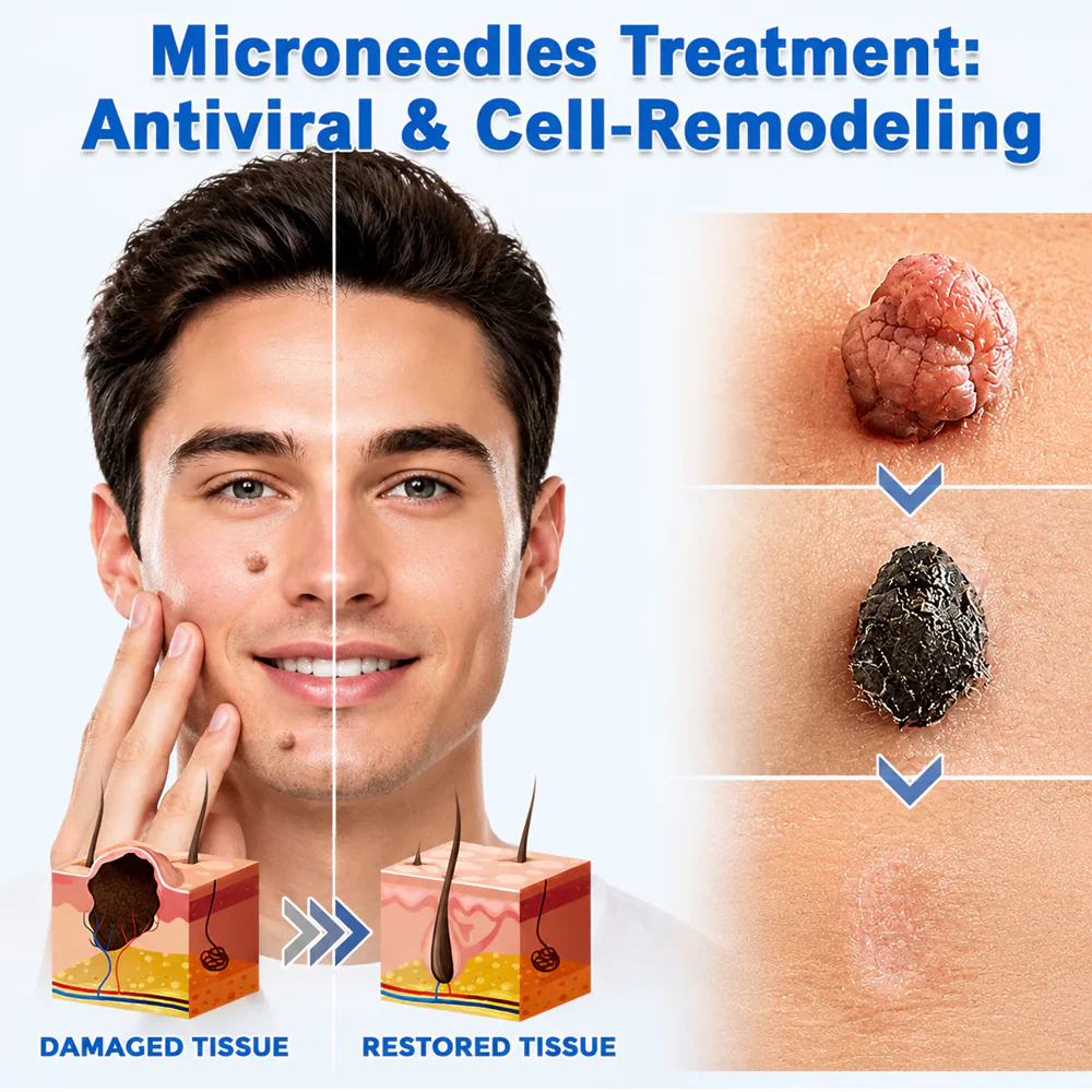 2-in-1 Microneedle & Hydrocolloid Patch👨‍⚕️ | Removes raised moles, acne, flat warts, and skin tags
