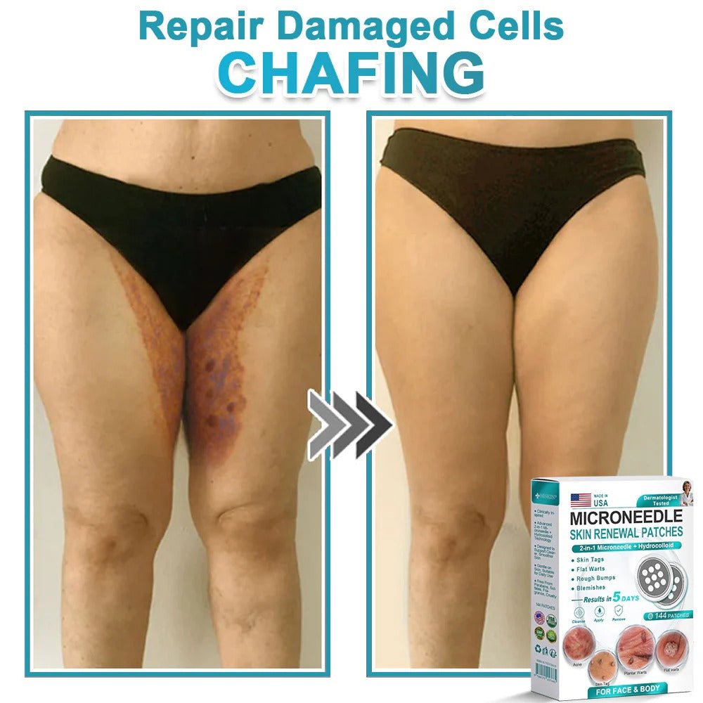 2-in-1 Microneedle & Hydrocolloid Patch👨‍⚕️ | Removes raised moles, acne, flat warts, and skin tags