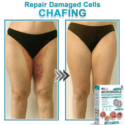 2-in-1 Microneedle & Hydrocolloid Patch👨‍⚕️ | Removes raised moles, acne, flat warts, and skin tags