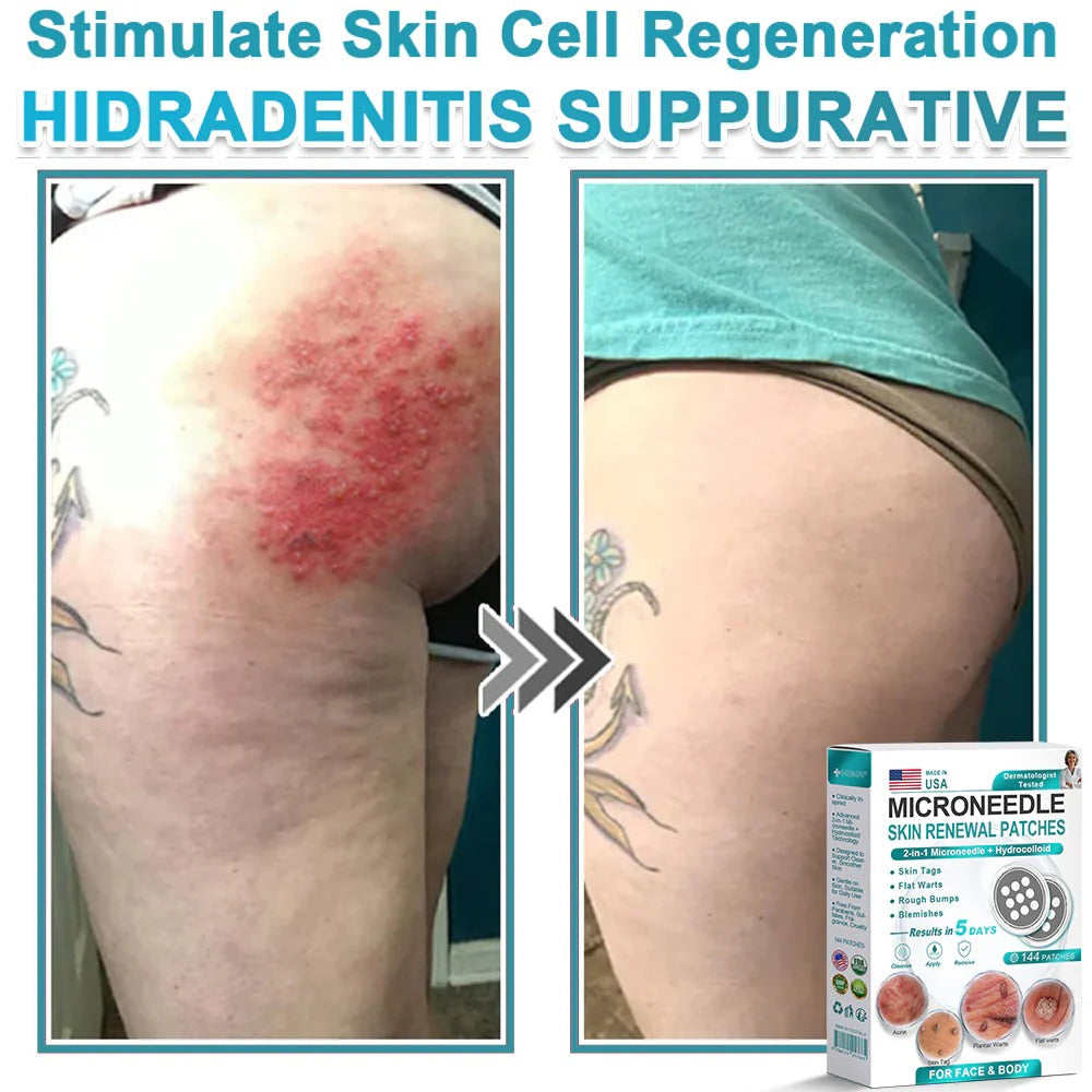2-in-1 Microneedle & Hydrocolloid Patch👨‍⚕️ | Removes raised moles, acne, flat warts, and skin tags