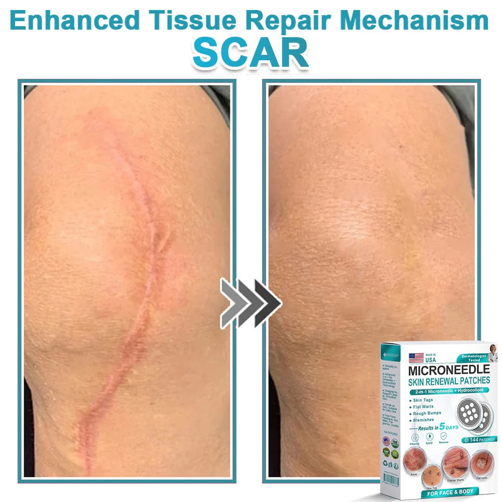 2-in-1 Microneedle & Hydrocolloid Patch👨‍⚕️ | Removes raised moles, acne, flat warts, and skin tags
