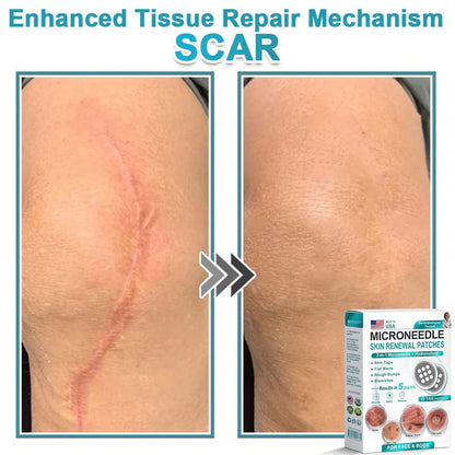 2-in-1 Microneedle & Hydrocolloid Patch👨‍⚕️ | Removes raised moles, acne, flat warts, and skin tags