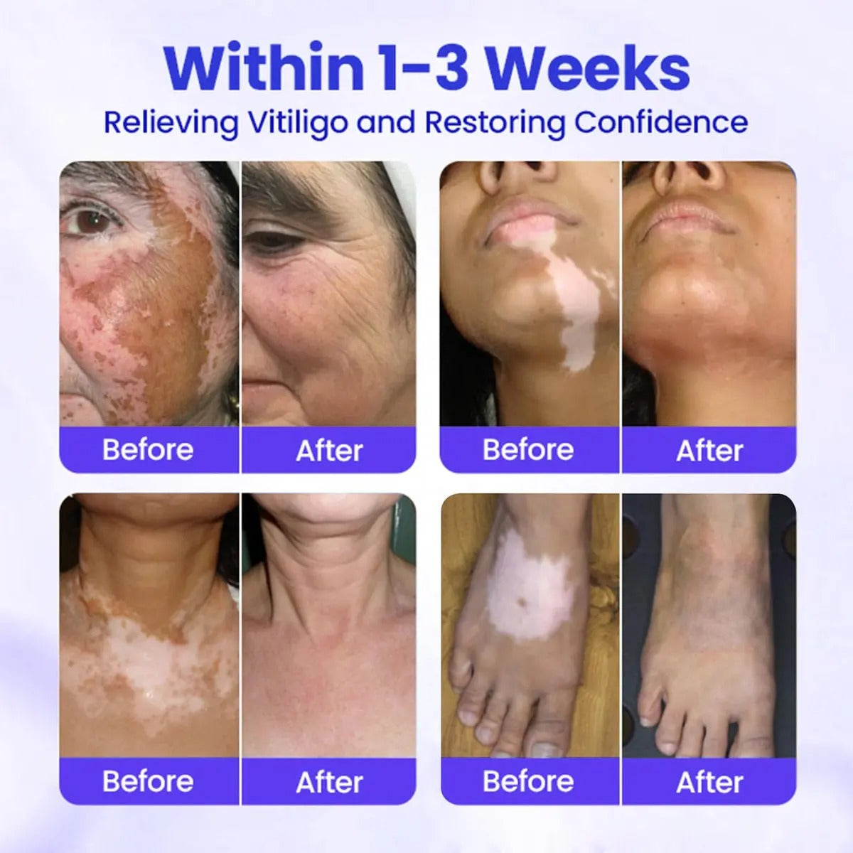 Vitiligo Treatment Spray-Professional White Spot Remover