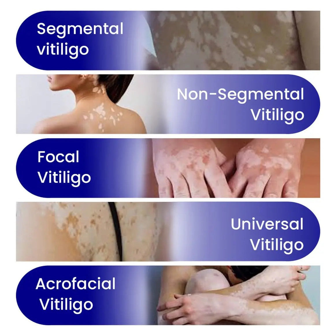 Vitiligo Treatment Spray-Professional White Spot Remover
